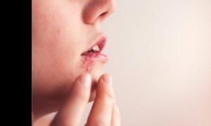 Dein Kleinkind hat im Kindergarten Lippenherpes bekommen? - eine vollständige Anleitung zur Lösung des Problems